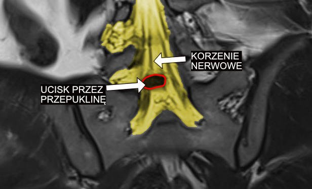 Ucisk na korzenie nerwowe w odcinku lędźwiowym 