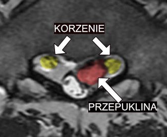 Ucisk na nerw kręgosłupa lędźwiowego