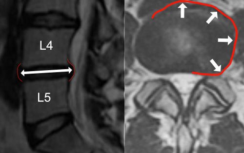 Wypuklina na poziomie L4 L5