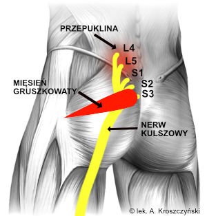 Podrażnienie nerwu kulszowego