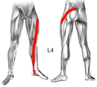 Zespół korzeniowy L4, objawy, przyczyny ucisku na korzenie nerwowego L4