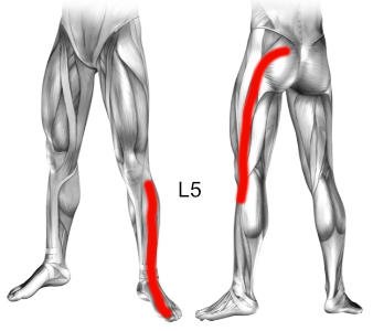 Zespół korzeniowy L5 objawy, przyczyny ucisku na korzenie nerwowego L5