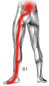 Zespół korzeniowy S1 objawy, przyczyny ucisku na korzenie nerwowego S1