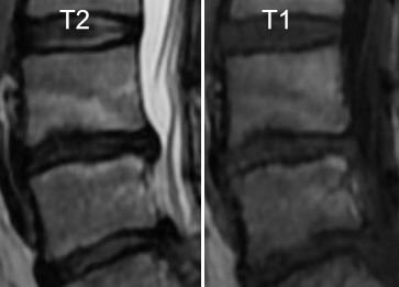 Zmiany typu Modic 1 – co oznacza obrzęk szpiku?