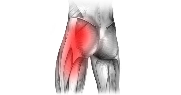 Ból pośladka – przyczyny, objawy, leczenie bólu
