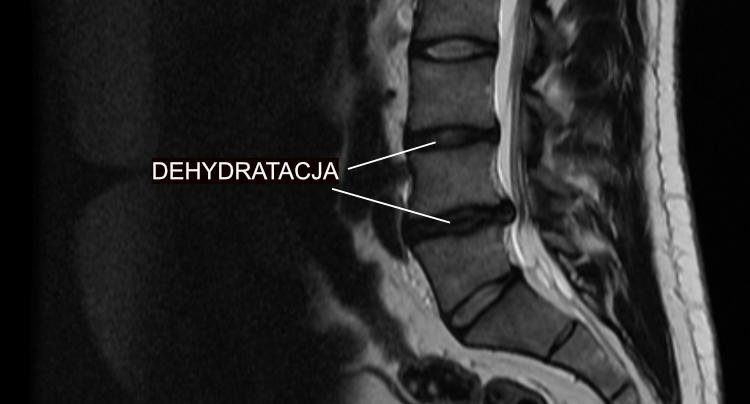 dehydratacja krążka
