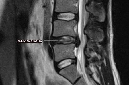 Odwodnienie krążków międzykręgowych