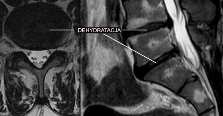 Dehydratacja krążków międzykręgowych – cechy dehydratacji