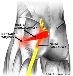 Zespół mięśnia gruszkowatego – obajwy