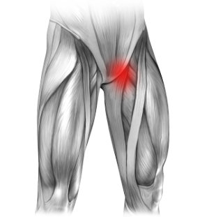 Neuralgia nerwu płciowo udowego i ból w lewej pachwinie promieniujący na nogę