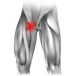 Neuralgia nerwu płciowo udowego i ból w prawej pachwinie promieniujący na nogę