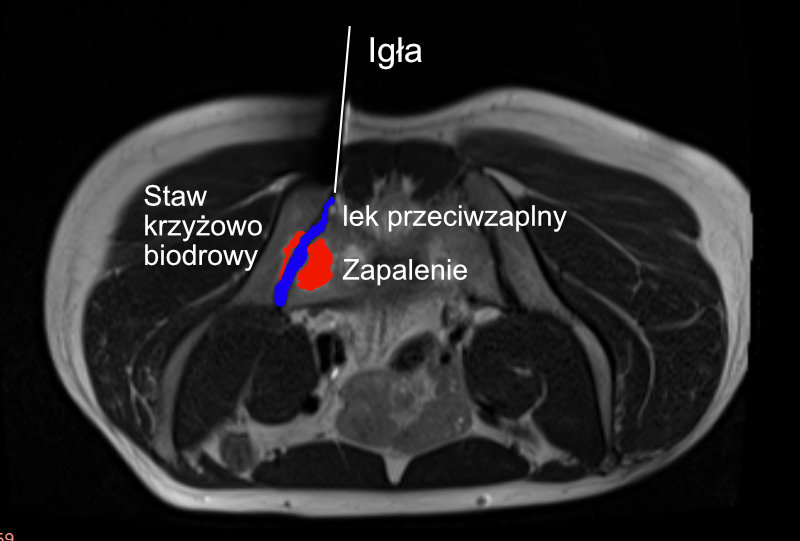 Zastrzyk do stawu krzyżowo biodrowego pod kontrolą rezonansu magnetycznego