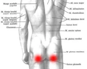 Guz kulszowy – ból pośladka i ból z tyłu uda pod pośladkiem