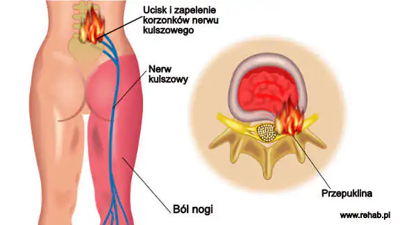 Przyczyny rwy kulszowej – dyskopatia i zapalenie nerwu kulszowego