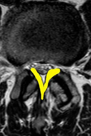 Pogrubiałe więzadła żółte w kręgosłupie ze zwężeniem kanału kręgowego