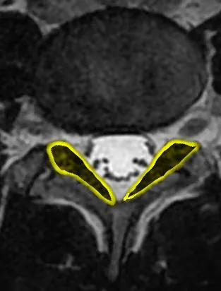 Normalne więzadła żółte w rezonansie magnetycznym