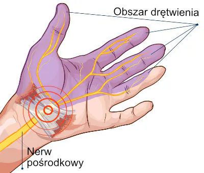 Drętwienie rąk - zespół cieśni nadgarstka